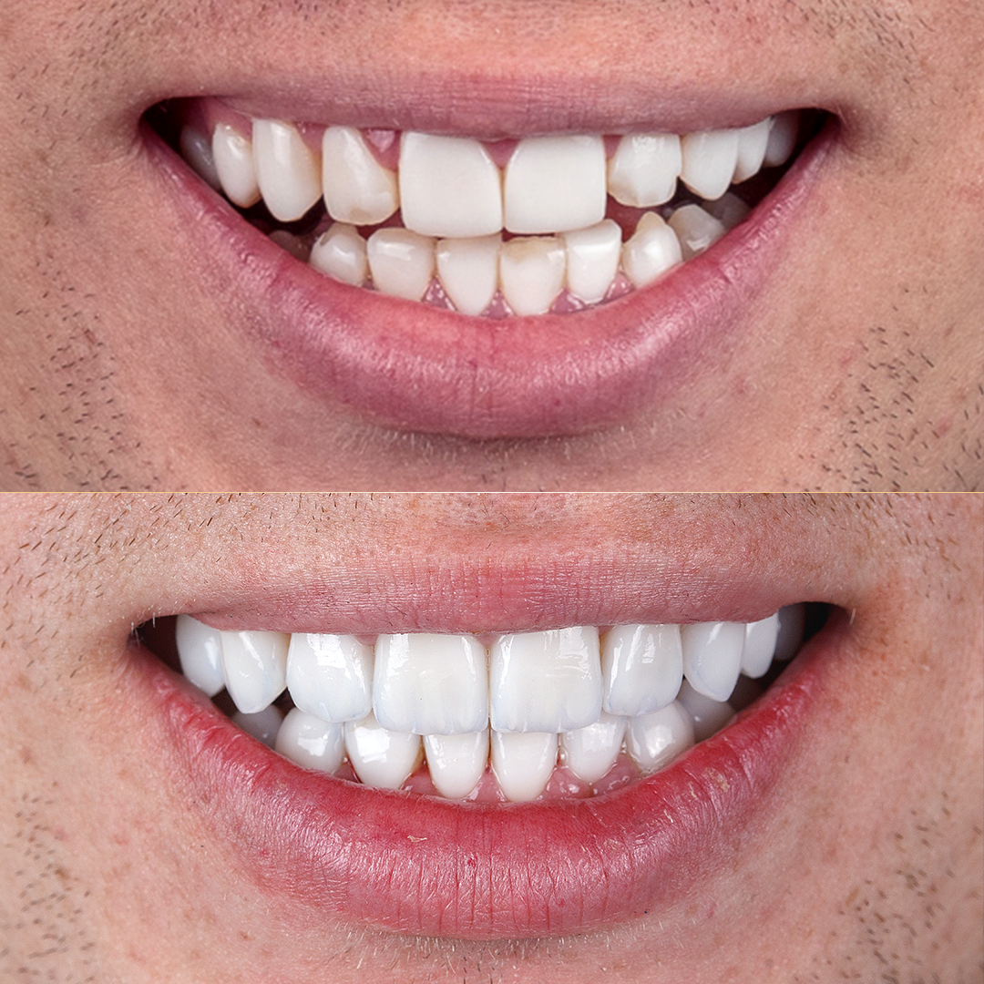 Dr Bruno Rattmann Lentes de Contato Dental Antes e Depois