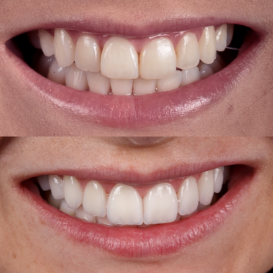 Dr Bruno Rattmann Lentes de Contato Dental Antes e Depois