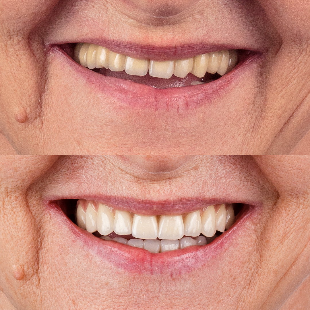 Dr Bruno Rattmann Lentes de Contato Dental Antes e Depois